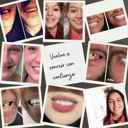 Carillas Dentales Instantáneas – Sonrisa Perfecta en Segundos - Amya Chile