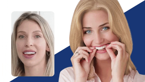 Carillas Dentales Instantáneas – Sonrisa Perfecta en Segundos