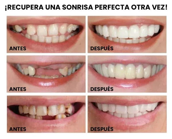 Carillas Dentales Instantáneas – Sonrisa Perfecta en Segundos - Amya Chile