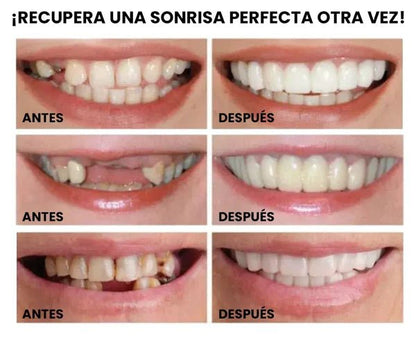 Carillas Dentales Instantáneas – Sonrisa Perfecta en Segundos - Amya Chile